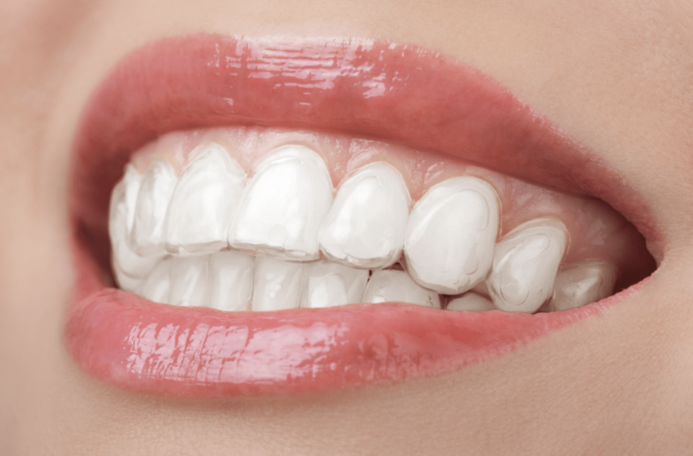 Gouttières Invisalign, Smilers : l'orthodontie invisible
